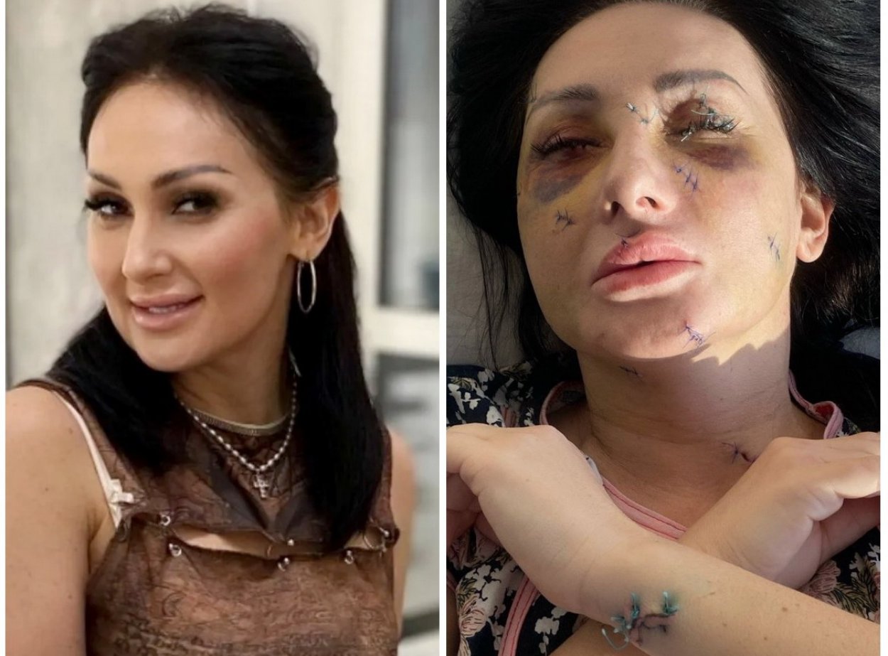 «Страдания и жизнь в аду»: ревнивый поклонник изрезал женщине лицо и лишил ее зрения